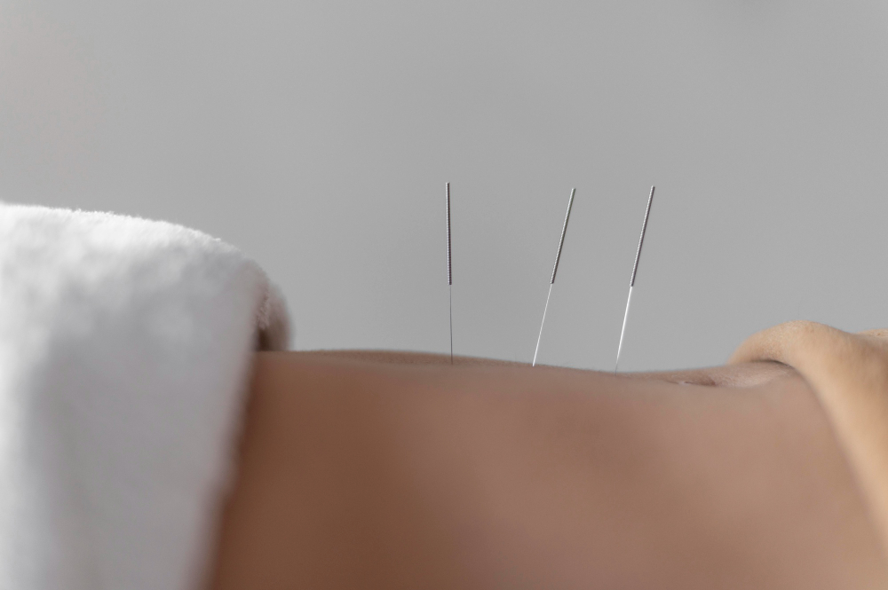 Cum te poate ajuta acupunctura